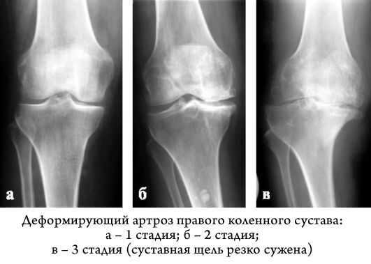 Лечение гонартроза коленного сустава 1 степени схема