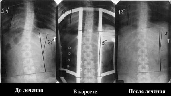 Сколиоз 1 2 степени фото