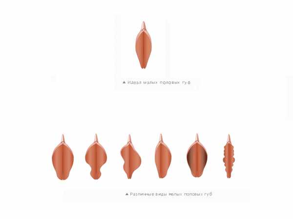 Коррекция половых губ фото до и после