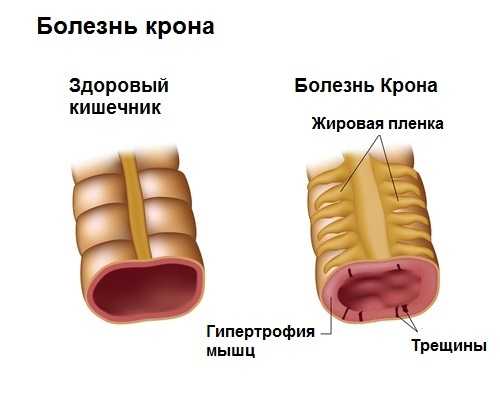 Язык при болезни крона фото