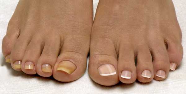 Грибок ногтей на ногах между пальцами ног фото