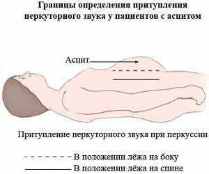 Асцит брюшной полости фото