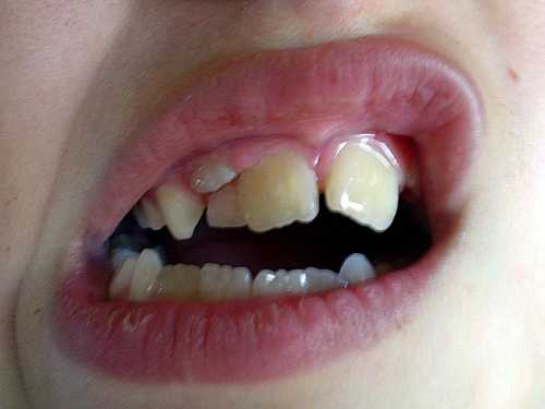 Как растут коренные зубы у детей фото