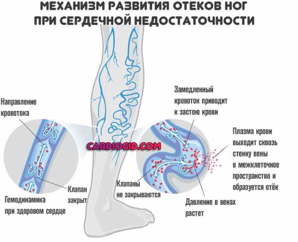 Отеки на фоне сердечной недостаточности