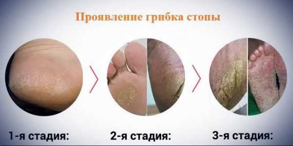 Как лечить синовит стопы. Синовит стопы: симптомы и лечение заболевания суставов Как лечить шпоры пяточной стопы: найдено 87 изображений Синовит голеностопного сустава: причины, симптомы, лечение