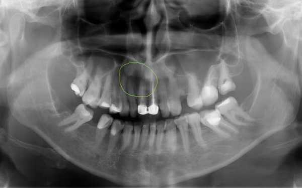 Как выглядит киста зуба на кт фото