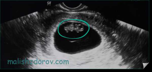 Как выглядит малыш на 9 неделе беременности в утробе фото