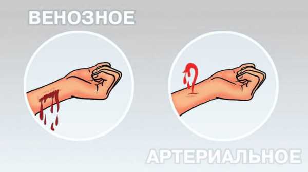 Определи какое кровотечение изображено на рисунке