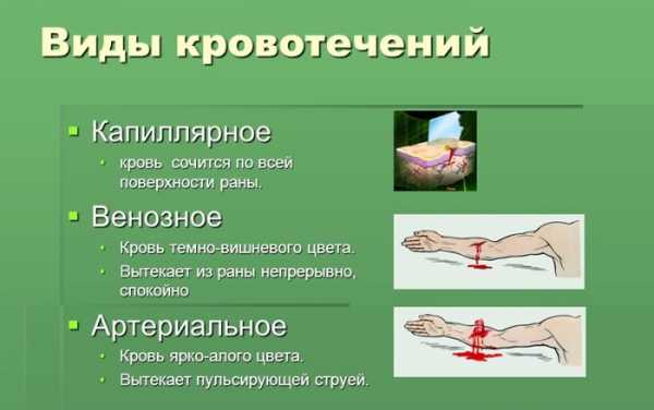 Определи какое кровотечение изображено на рисунке