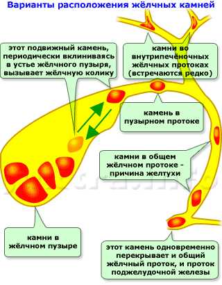 Какие бывают камни в желчном пузыре по составу фото