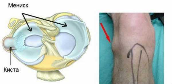 Киста бейкера коленного фото