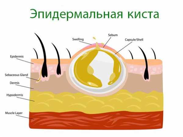 Киста сальной железы на лице фото