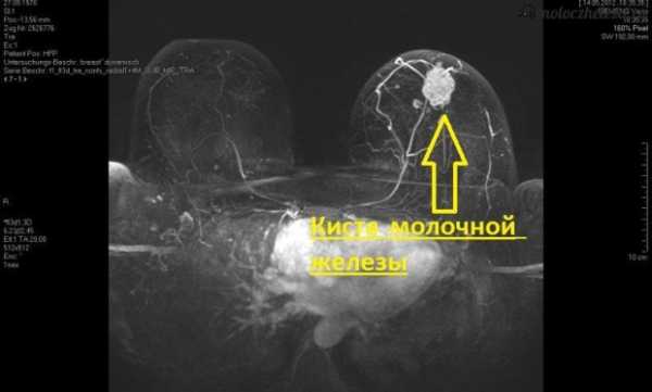 Как выглядит фиброзно кистозная мастопатия фото