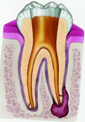 Как выглядит киста зуба на кт фото