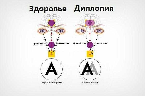 Зрение двоится изображение причины