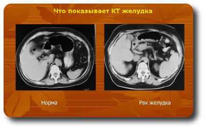 Компьютерная томография желудка и кишечника что показывает