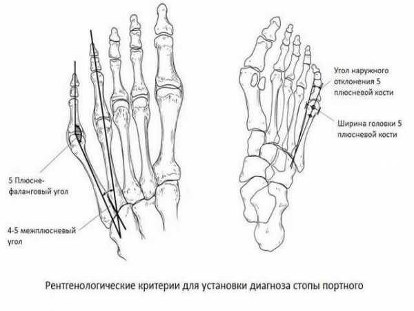 Плюсневая кость стопы где находится 5 фото