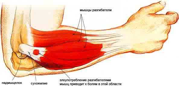 Латеральный эпикондилит фото
