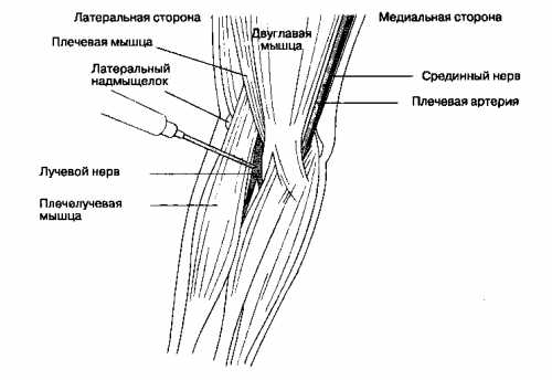 Латеральный эпикондилит локтевого сустава симптомы и лечение фото