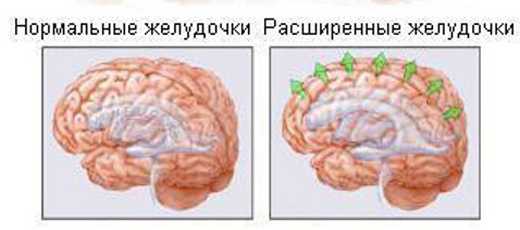Гидроцефалия головного мозга у взрослого человека фото
