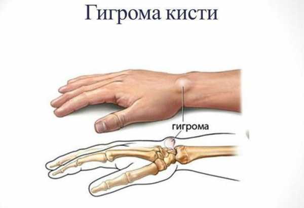 Гигрома на колене. Шишка на запястье с внутренней стороны - гигрома: симптомы, причины. Гигрома, что это, лечение, симптомы, причины Гигрома - симптомы, причины появления, диагностика, лечение