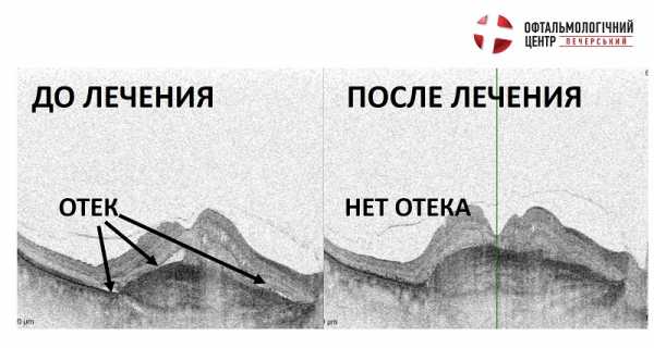 Возрастная макулодистрофия презентация