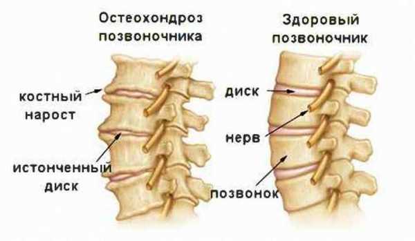 Цервикобрахиалгия справа на фоне шейного остеохондроза лечение отзывы симптомы