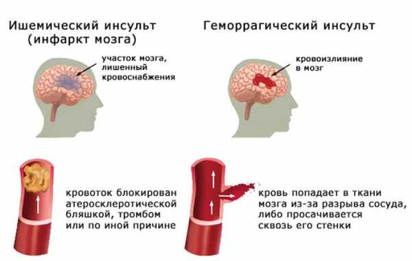 Отек головного мозга на фоне алкогольной интоксикации