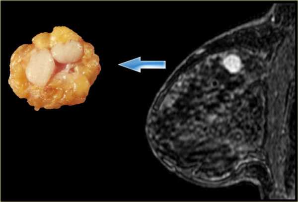 Фиброаденома груди фото