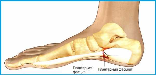 Болят ступни ног при наступании причины и лечение народными средствами фото