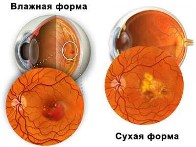 Возрастная макулодистрофия презентация