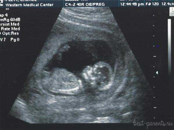 Как выглядит малыш на 13 неделе беременности фото