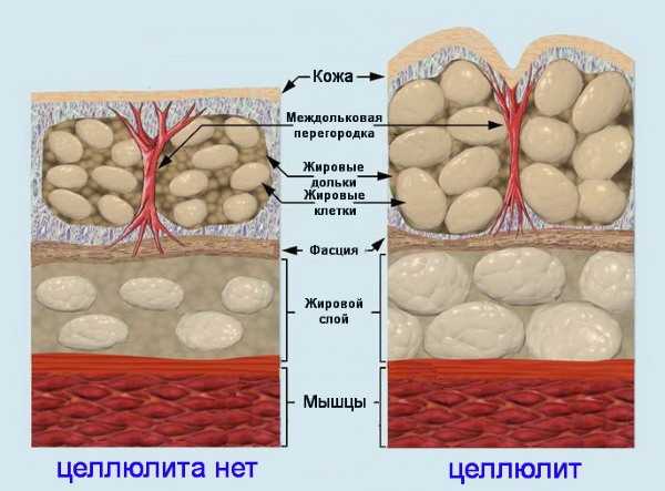 Целлюлит на ногах картинки