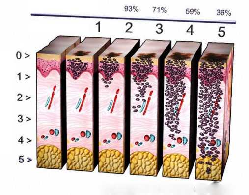 Меланома 3 стадии фото
