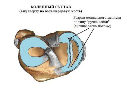 Где находится мениск в колене правой ноги рисунок