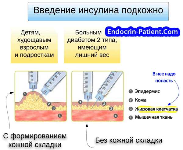 Места для укола инсулина картинки