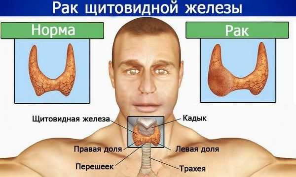 Метастазы в сальнике прогноз