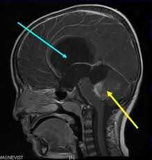 Мр картина наружной заместительной гидроцефалии