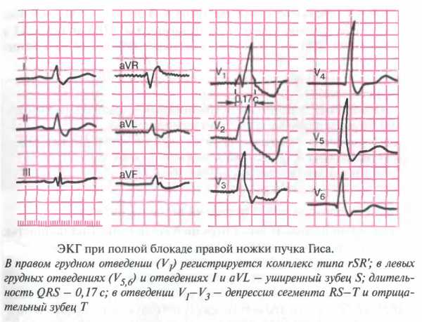 Картинки полная блокада левой ножки пучка гиса