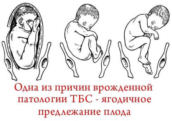 Незрелость тазобедренных суставов у. Незрелость тазобедренных суставов у новорожденного - YouTube Движения в тазобедренном суставе: сгибание, разгибание, отведение. Дисплазия тазобедренных суставов причины, симптомы и лечение дисплазии.