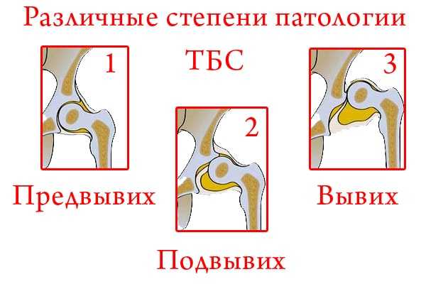 Схема тазобедренного сустава рисунок с подписями