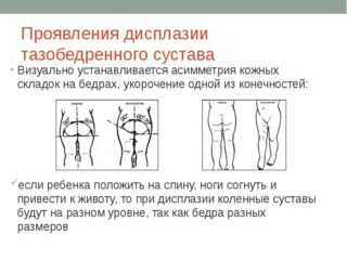 Незрелость тазобедренных суставов у новорожденных лечение. Незрелость тазобедренных суставов у новорожденного - YouTube Недоразвитость тазобедренных суставов – Физиологическая незрелость. Тазобедренный сустав у грудничков: норма, признаки дисплазии и лечение