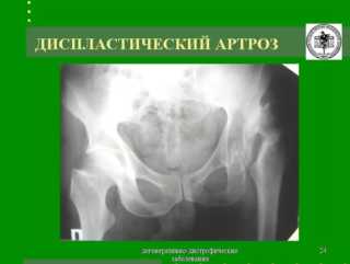 Незрелость тазобедренного сустава у младенца. Гипоплазия тазобедренного сустава у детей и последствия: Дисплазия. УЗИ тазобедренных суставов новорожденных: норма и патология Дисплазия тазобедренных суставов у ребенка - лечение