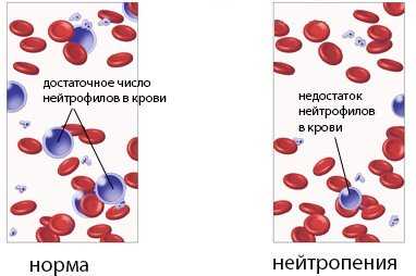 Лимфоцитоз на фоне нейтропении у ребенка