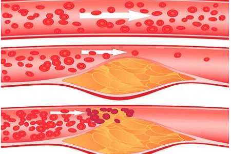 Облитерирующий атеросклероз фото