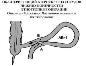 Облитерирующий атеросклероз фото