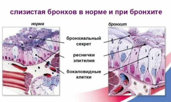 Обструктивный бронхит на фоне аллергии у детей