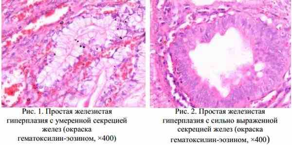 Простая железистая гиперплазия эндометрия