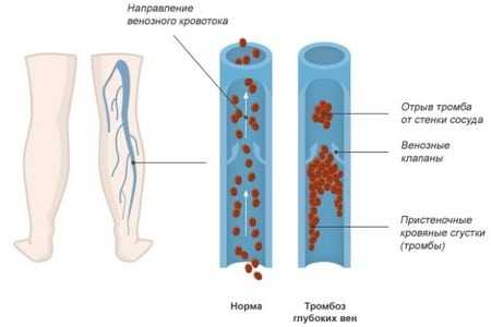 Тромбоз поверхностных вен нижних конечностей фото