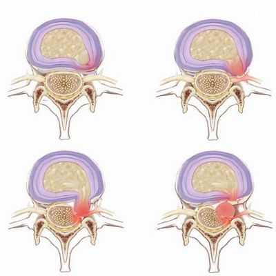 Позвоночная грыжа симптомы картинки